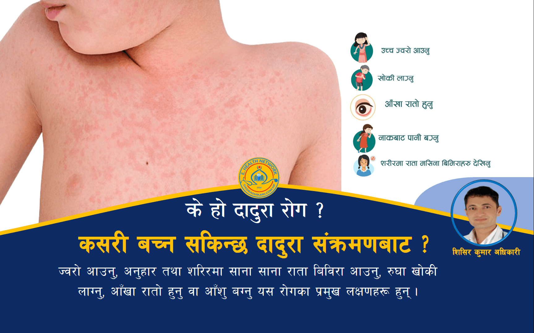 दादुरा रोग (Measles)